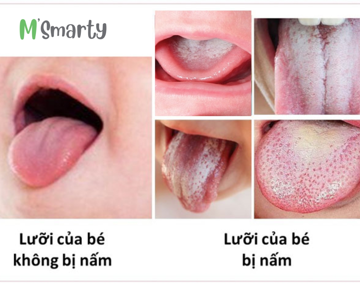 Cách trị trắng lưỡi cho trẻ sơ sinh hiệu quả và các phương pháp giảm nguy cơ trẻ bị trắng lưỡi 3