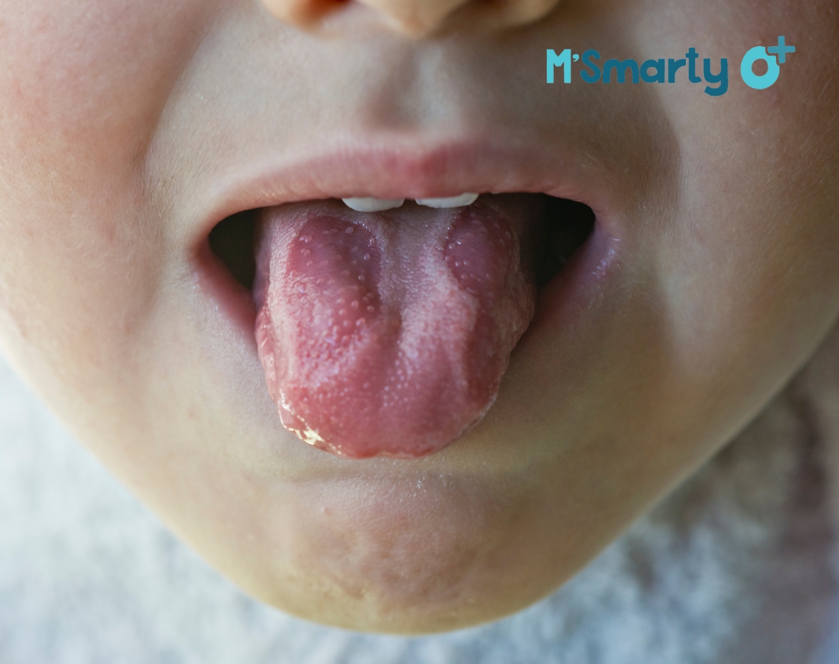 Các bệnh về lưỡi ở trẻ em mà mẹ cần biết 1